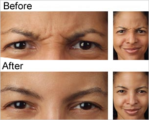 Botox® Before & After Photos, Tampa Ear, Nose And Throat Specialists